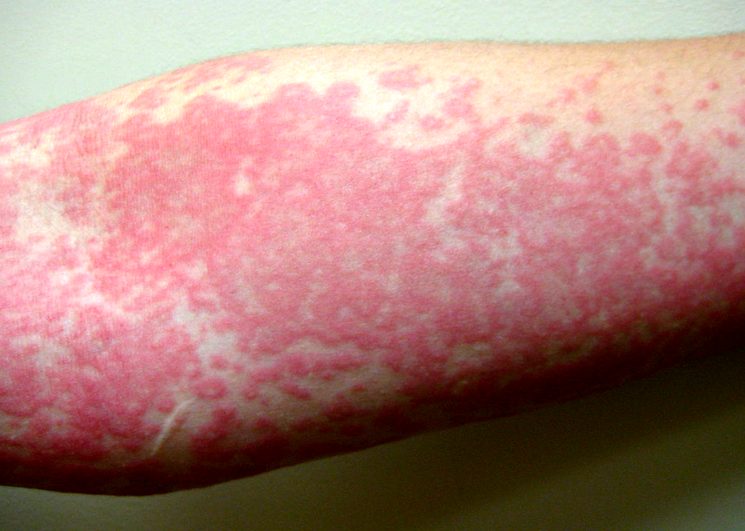 Аллергия на чеснок у ребенка фото thumbnail